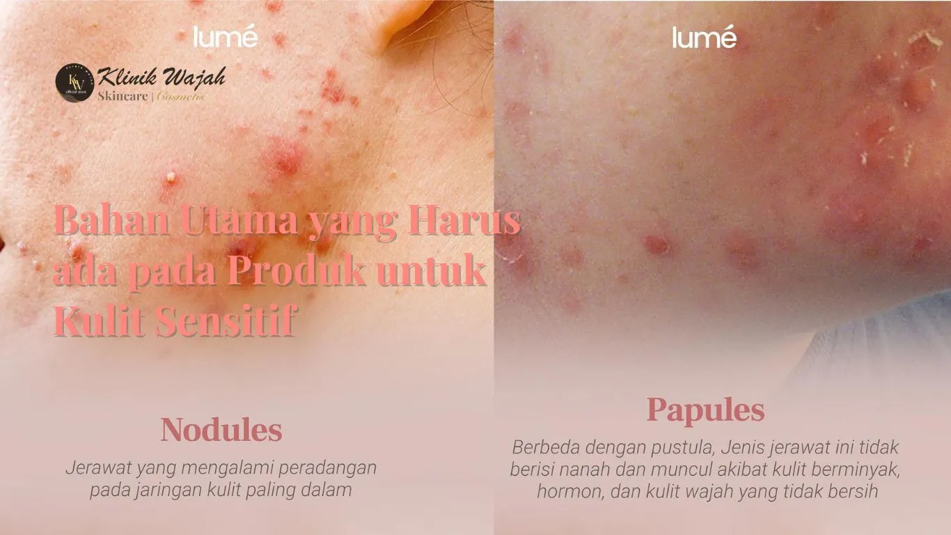 7 Bahan Utama Harus ada pada Produk untuk Kulit Sensitif