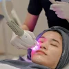 Apa Saja Manfaat Laser Wajah? 7 Beberapa Diantaranya!